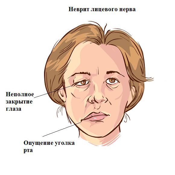 Лечение неврита лицевого нерва в Санкт-Петербурге